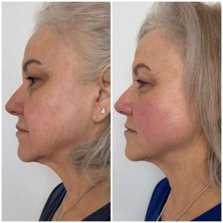 trilift before and after image shoing improvments in skin tone and pigmentation for female